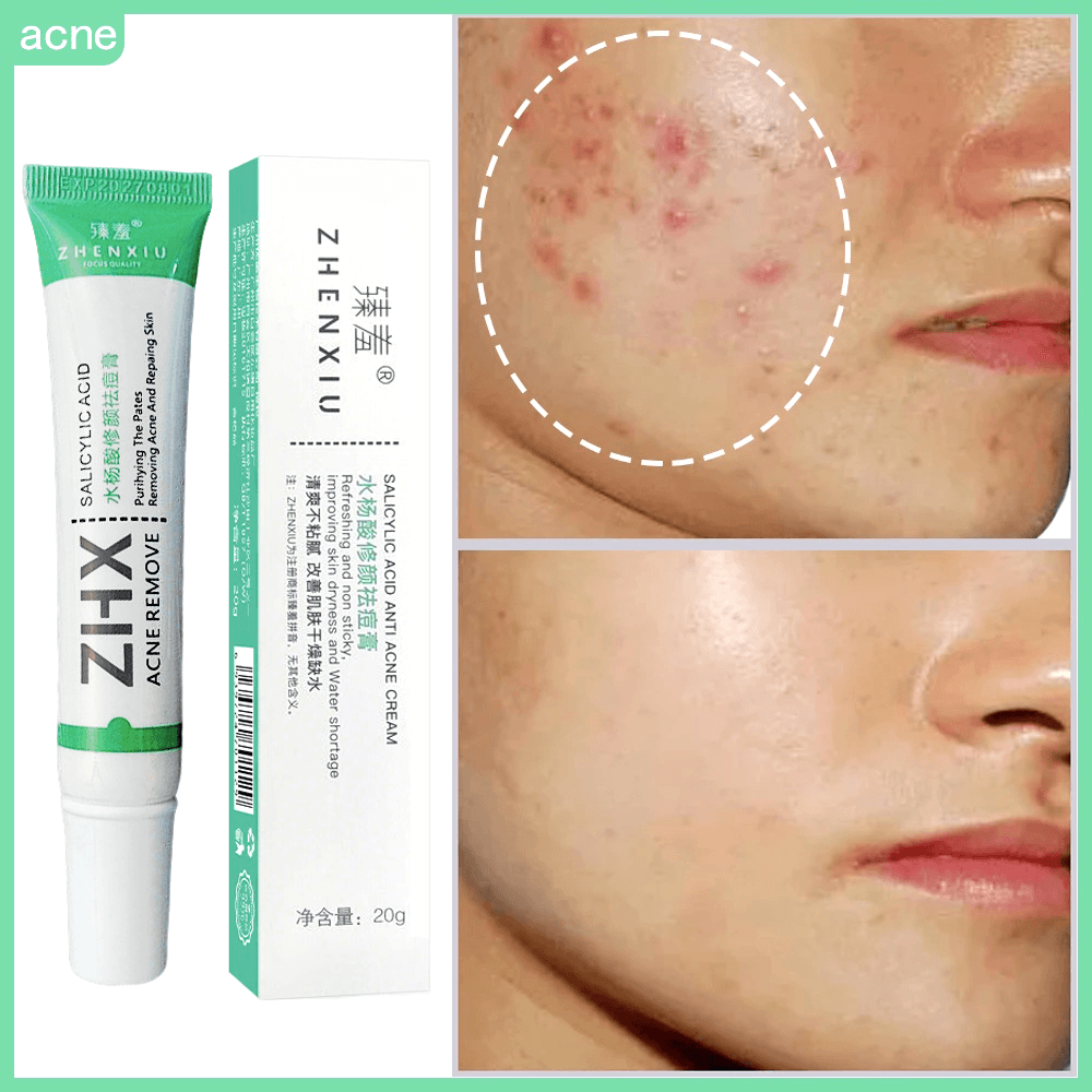 Ácido Salicílico Acne Creme Remover Cravo Controle De Óleo Anti-Tratamento Reparação Espinha Cicatriz Clareamento Facial